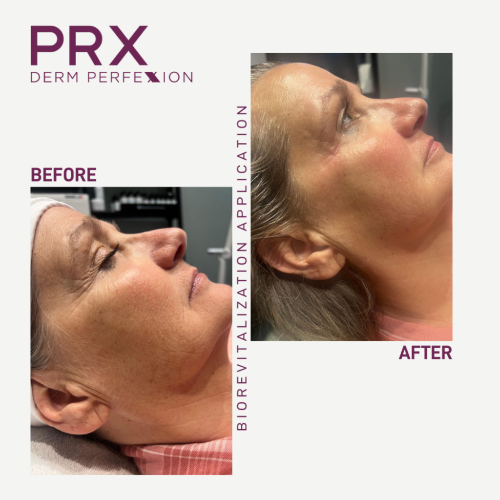 before and after results of PRX DERM PERFEXION treatment